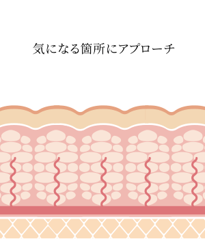 キャビテーション